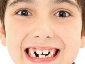 Kenali Penyebab Gigi Anak Berantakan Dan Maju Ke Depan