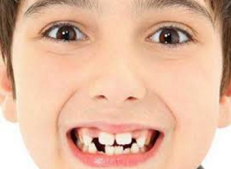 Kenali Penyebab Gigi Anak Berantakan Dan Maju Ke Depan